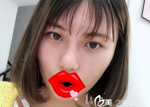 在嘉興曙光做完隆鼻手術(shù)10天效果 在嘉興曙光做完隆鼻手術(shù)10天效果