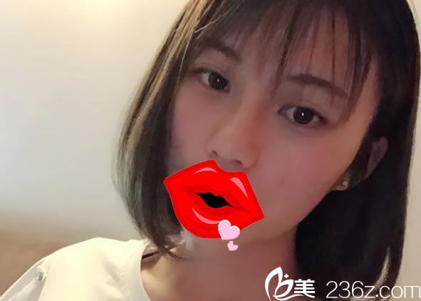 曙光王旭明鼻綜合案例20天效果 曙光王旭明鼻綜合案例20天效果