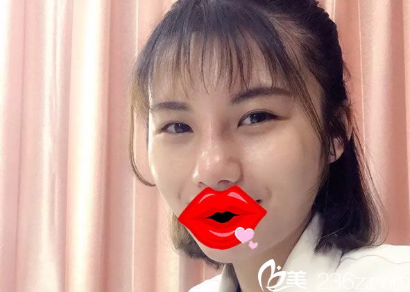 做完自體軟骨隆鼻手術(shù)后工作照 做完自體軟骨隆鼻手術(shù)后工作照