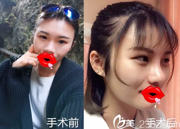 嘉興曙光自體軟骨隆鼻案例對(duì)比圖 嘉興曙光自體軟骨隆鼻案例對(duì)比圖