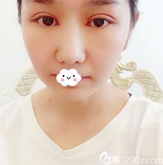 淮北微悅（伊爾美）醫(yī)療美容門診部雙眼皮案例