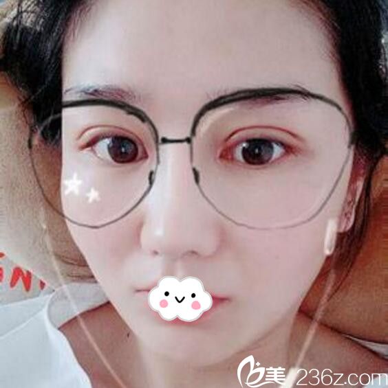 淮北微悅（伊爾美）醫(yī)療美容門診部雙眼皮+開眼角