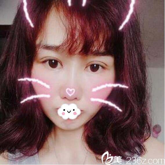 淮北微悅（伊爾美）醫(yī)療美容門診部全切雙眼皮+開眼角案例