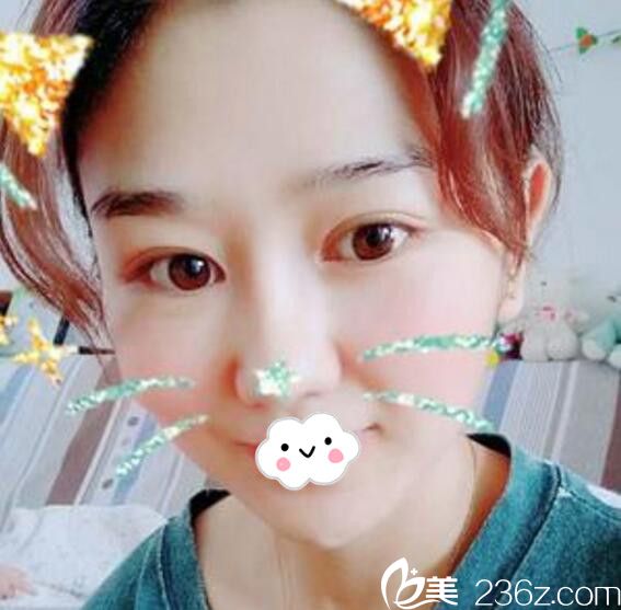 想做雙眼皮到淮北微悅（伊爾美）吳磊處做美杜莎眼綜合成功將我的“土氣”蛻去！