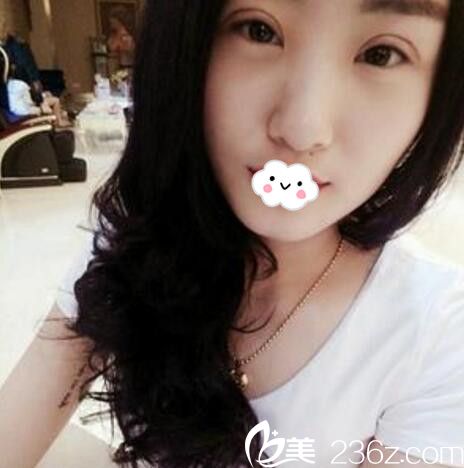 淮北微悅(伊爾美)醫(yī)療美容門診部胡斌全切雙眼皮術(shù)后效果 淮北微悅(伊爾美)醫(yī)療美容門診部胡斌全切雙眼皮術(shù)后效果