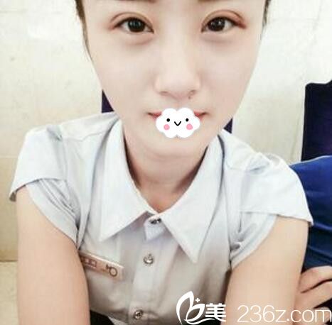 淮北微悅(伊爾美)醫(yī)療美容門診部胡斌全切雙眼皮案例 淮北微悅(伊爾美)醫(yī)療美容門診部胡斌全切雙眼皮案例