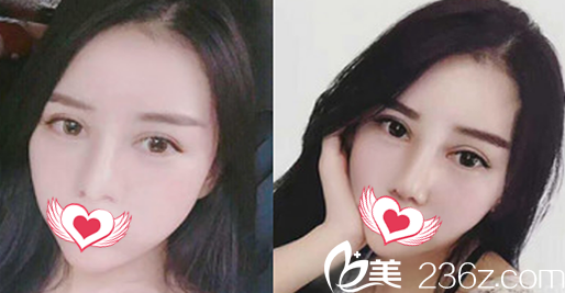 我在蚌埠國色做鼻綜合隆鼻全過程感受 讓大家見證下我蛻變的過程