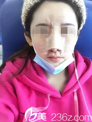 術(shù)后即刻效果 術(shù)后即刻效果