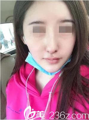 術(shù)后三天效果 術(shù)后三天效果