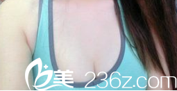 術(shù)后一個月的樣子 術(shù)后一個月的樣子