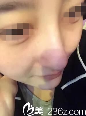 拆線后效果 拆線后效果