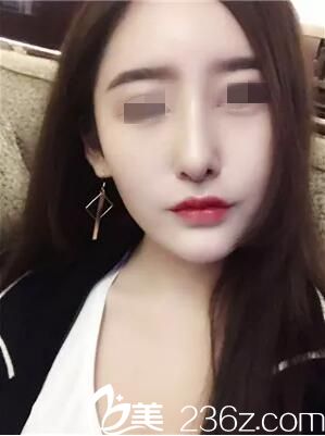 術(shù)后半個月效果 術(shù)后半個月效果