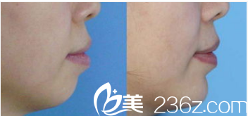 韓國(guó)LK整形外科醫(yī)院案例 韓國(guó)LK整形外科醫(yī)院案例