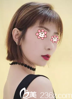 重慶美侖美奐整形姬廣翰顴弓內(nèi)推+下頜角切除術(shù)后3個(gè)月 重慶美侖美奐整形姬廣翰顴弓內(nèi)推+下頜角切除術(shù)后3個(gè)月