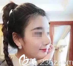 常德伊麗莎白盧開銳院長(zhǎng)給我做的鼻失敗修復(fù)兩個(gè)月恢復(fù)過程