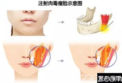 醫(yī)生解析瘦臉的原理 醫(yī)生解析瘦臉的原理