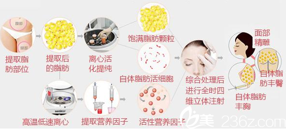 醫(yī)生講解自體脂肪活細(xì)胞移植過程