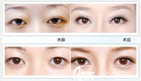 悅美整形美容醫(yī)院雙眼皮案例 悅美整形美容醫(yī)院雙眼皮案例