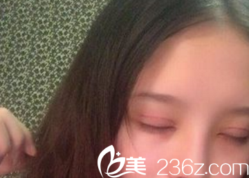 雙眼皮術(shù)后一周拆線