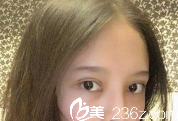 割雙眼皮術(shù)后20天效果