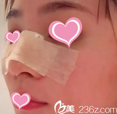 術(shù)后第三天的樣子 術(shù)后第三天的樣子