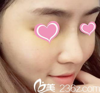 術(shù)后一個月的照片 術(shù)后一個月的照片