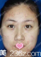 北京米蘭柏羽麗都醫(yī)療美容醫(yī)院案例術(shù)前照 北京米蘭柏羽麗都醫(yī)療美容醫(yī)院案例術(shù)前照