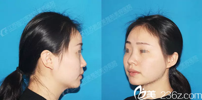 術(shù)前蒜頭鼻明顯 術(shù)前蒜頭鼻明顯