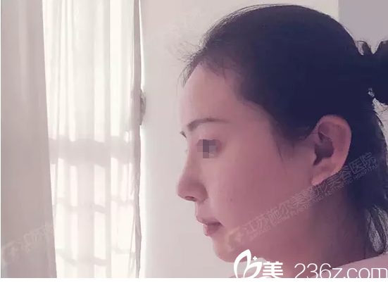 術(shù)后七天拆線恢復(fù)中 術(shù)后七天拆線恢復(fù)中