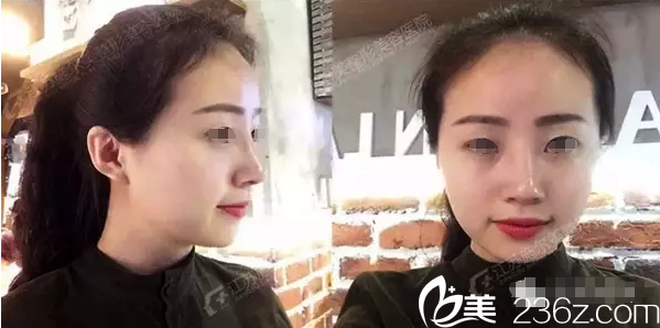 拆線術(shù)后恢復(fù)中 拆線術(shù)后恢復(fù)中