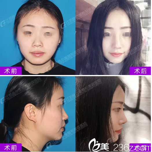 在江蘇施爾美做鼻綜合術(shù)前術(shù)后對(duì)比 在江蘇施爾美做鼻綜合術(shù)前術(shù)后對(duì)比