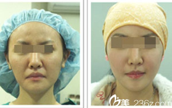 韓國美人制造整形醫(yī)院顴骨手術案例 韓國美人制造整形醫(yī)院顴骨手術案例