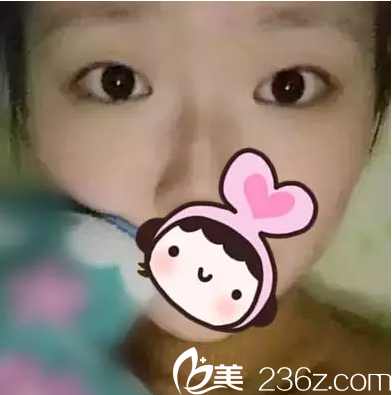 手術(shù)前單眼皮的我 手術(shù)前單眼皮的我