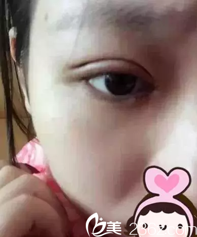 術(shù)后第三天 術(shù)后第三天