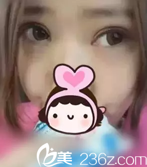 術(shù)后第22天 術(shù)后第22天