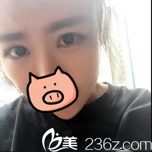 昆明夢想醫(yī)療美容醫(yī)院李勁良眼綜合真人案例 昆明夢想醫(yī)療美容醫(yī)院李勁良眼綜合真人案例