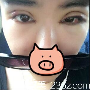 開內(nèi)眼角+全切雙眼皮真人案例術(shù)后天 開內(nèi)眼角+全切雙眼皮真人案例術(shù)后天