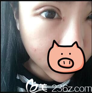 開內(nèi)眼角+全切雙眼皮真人案例術(shù)后第七天 開內(nèi)眼角+全切雙眼皮真人案例術(shù)后第七天