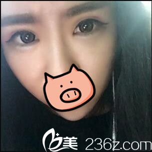 開內(nèi)眼角+全切雙眼皮真人案例術(shù)后二十天天 開內(nèi)眼角+全切雙眼皮真人案例術(shù)后二十天天