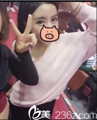 開內(nèi)眼角+全切雙眼皮真人案例術(shù)后三十三天 開內(nèi)眼角+全切雙眼皮真人案例術(shù)后三十三天