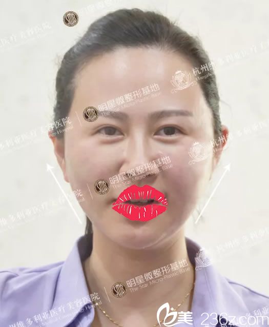 面部線雕提升術后即刻效果圖