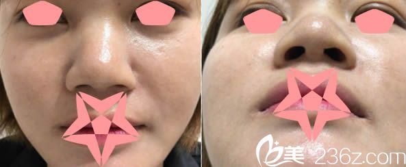 在福州瑪恩整形醫(yī)院做鼻子術(shù)前照 在福州瑪恩整形醫(yī)院做鼻子術(shù)前照