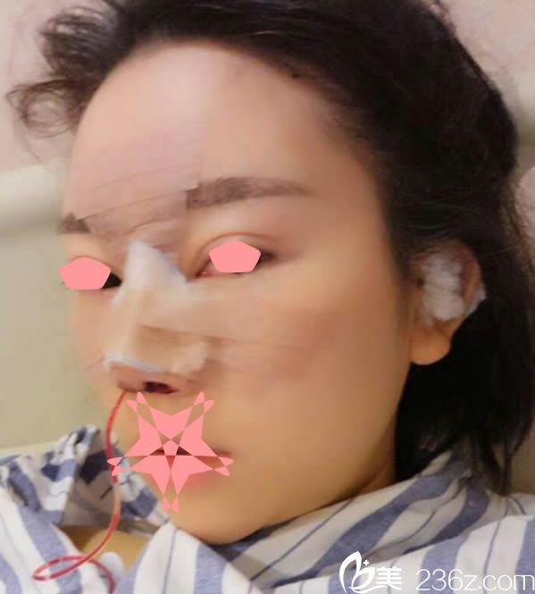 做完鼻綜合手術(shù)第1天的樣子 做完鼻綜合手術(shù)第1天的樣子