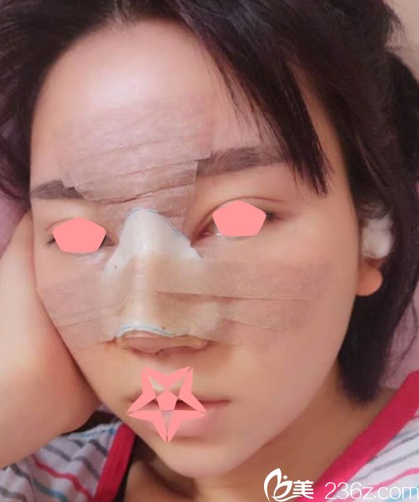 鼻翼內(nèi)切和耳軟骨墊鼻尖術(shù)后第2天 鼻翼內(nèi)切和耳軟骨墊鼻尖術(shù)后第2天