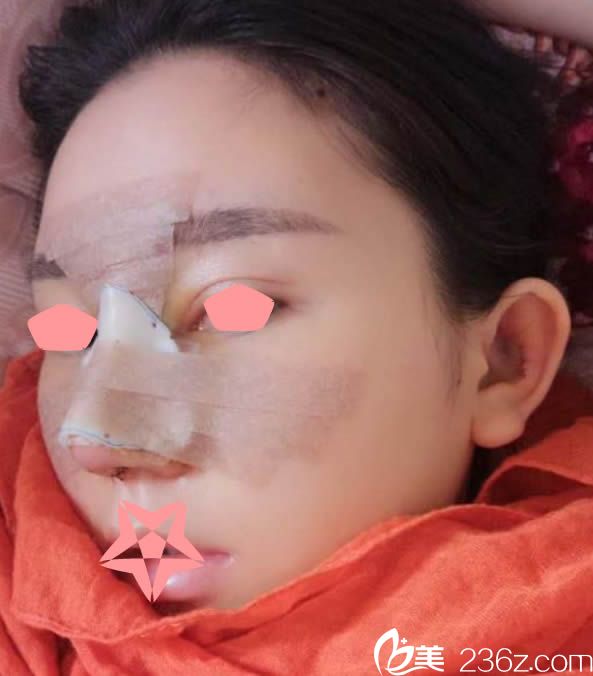 綜合隆鼻術(shù)后第4天 綜合隆鼻術(shù)后第4天