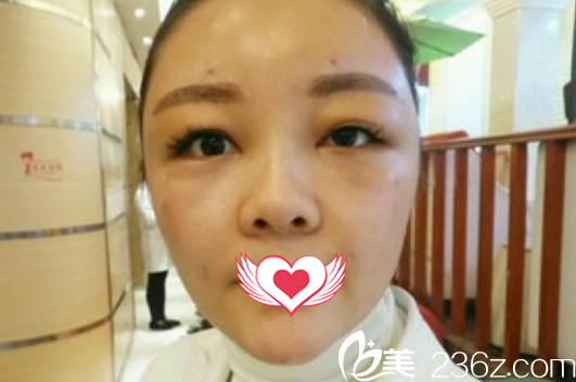 在亳州締美整形做自體脂肪能填充面部術(shù)后第1天恢復(fù)情況