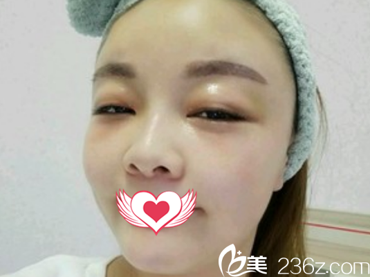 找亳州締美邢志平做自體脂肪填充面部術(shù)后第6天恢復(fù)效果展示