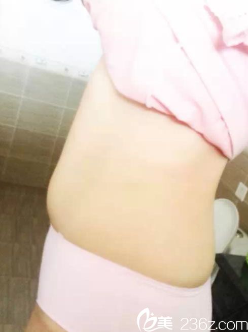 在金華亞美做腰腹吸脂前 在金華亞美做腰腹吸脂前