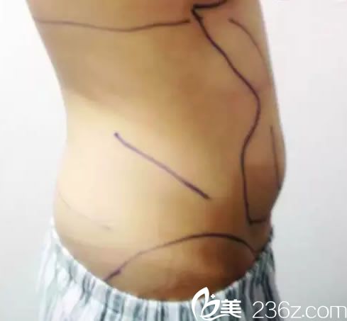 金華亞美趙延嶺設(shè)計(jì)吸脂方案 金華亞美趙延嶺設(shè)計(jì)吸脂方案