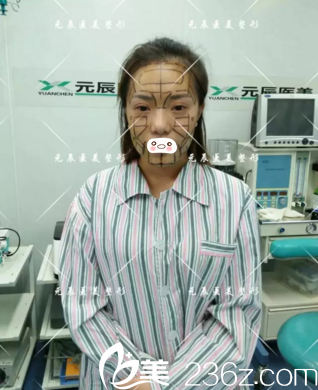 術(shù)前設(shè)計(jì)劃線 術(shù)前設(shè)計(jì)劃線